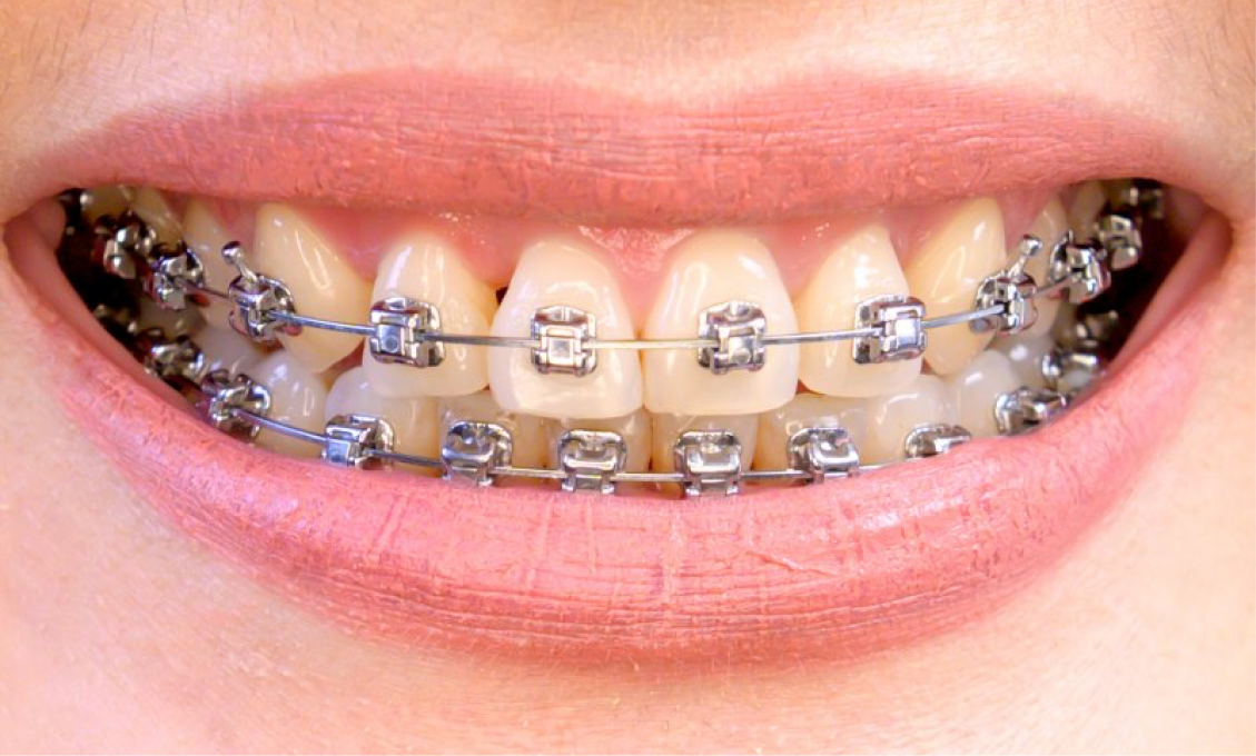 ใครบ้างที่เหมาะกับการจัดฟัน