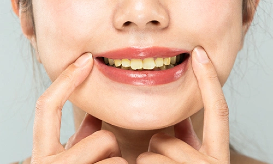 สาเหตุที่ทำให้ฟันเหลือง