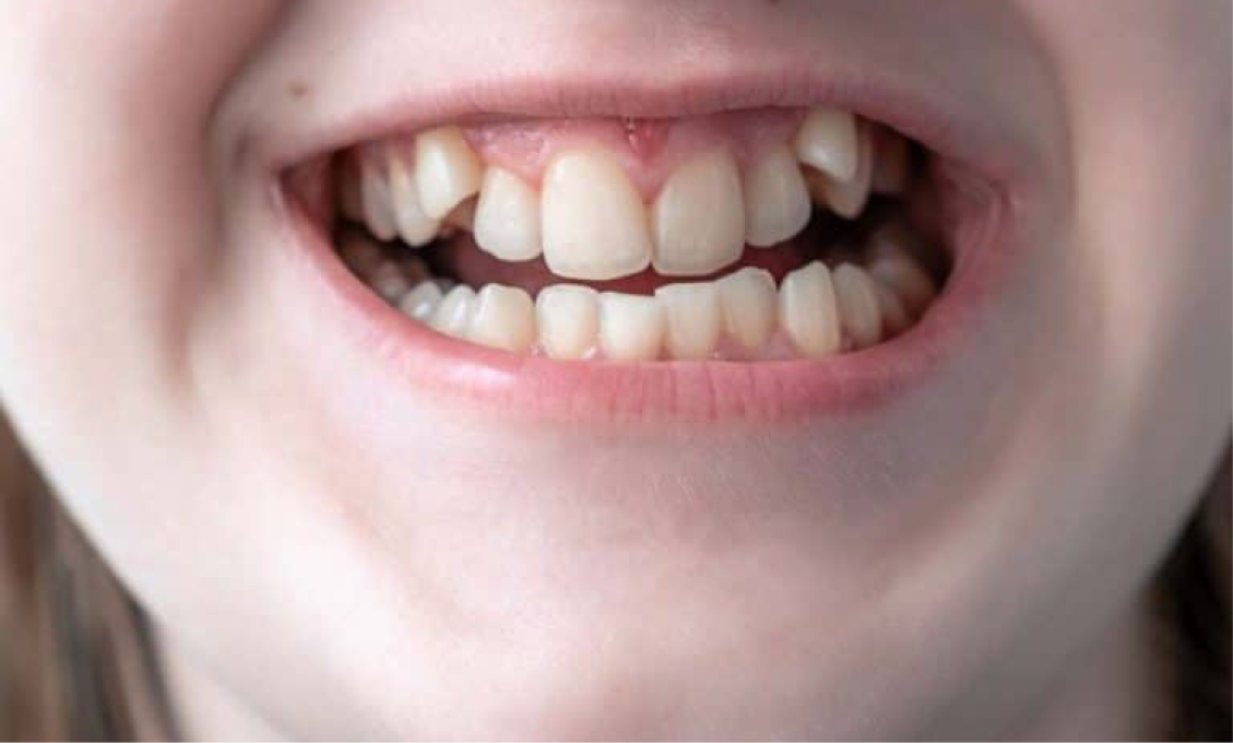 ปวดหัวกับฟันซ้อนเก อยากจัดฟันแต่กลัวเสียบุคลิกเวลาคุยงานใช่ไหม?